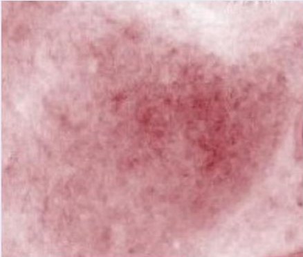 Redness map of the cheek after a cold test, day 0