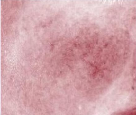 Redness map of the cheek after a cold test, day 28