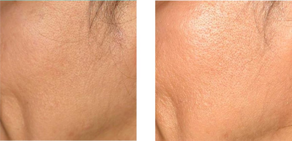 Before and after photos of the crow's-feet area