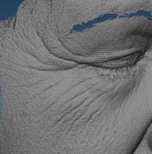 3D surface scans of crow's feet before and after treatment