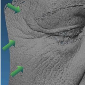 3D scan of the eye area with arrows showing the lifting direction