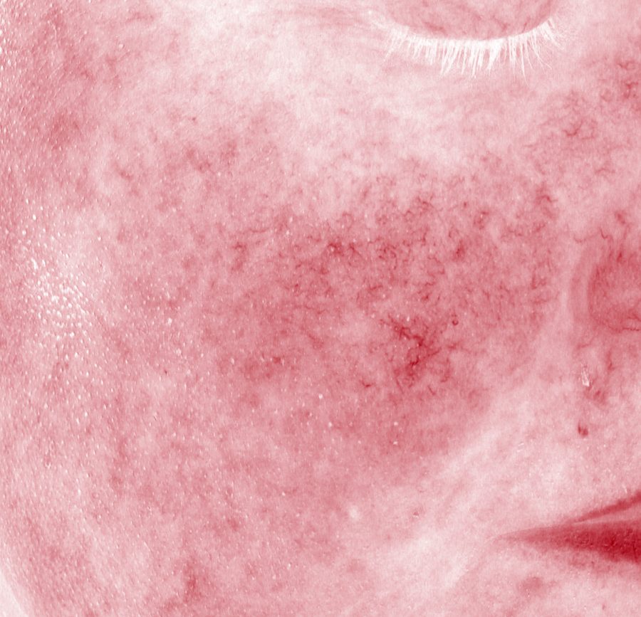 Thermal-style image of a cheek showing areas of redness