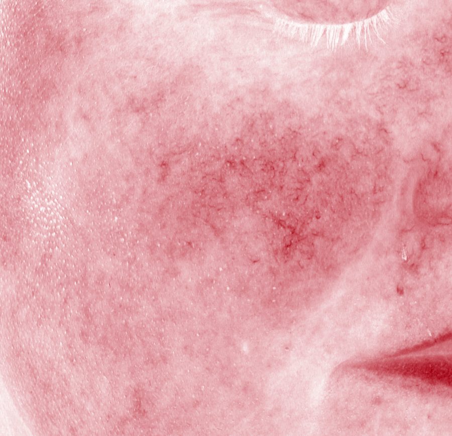 Thermal-style image of the same cheek with less redness after 28 days