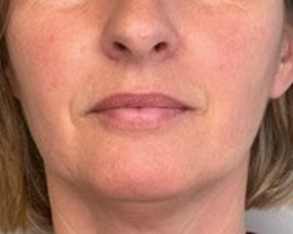Volunteer's lips on day 0 of the Joybliss ingredient study