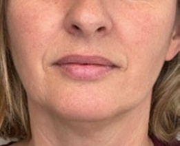 The same volunteer's lips on day 28, looking fuller