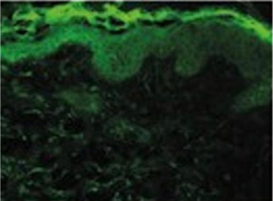 Skin sample after radiation, without carnosine